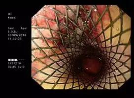 食管癌吞不下饭怎么办,食管肿瘤吃不下东西怎么减轻痛苦