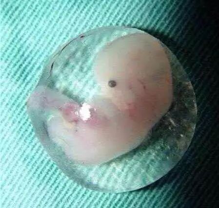 宫外孕是不是特别危险,宫外孕的危险到底有多可怕