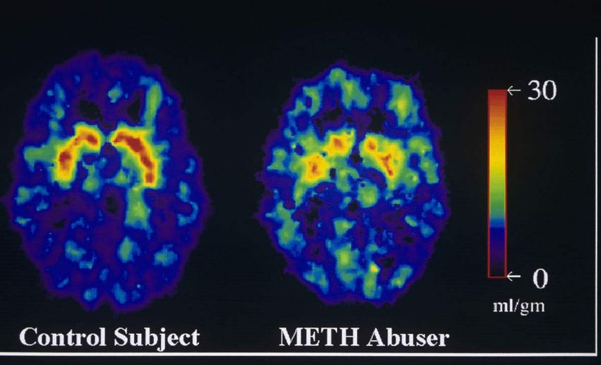 吸毒人会得抑郁症吗,吸毒的人会抑郁症么