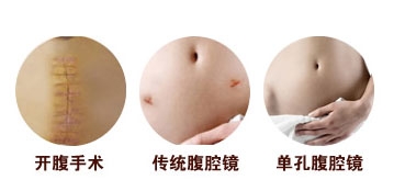 腹腔镜手术和微创手术有区别吗,腹腔镜手术是微创手术吗