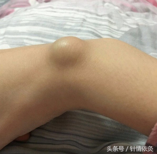 针灸治疗腱鞘囊肿的最新视频,中医腱鞘囊肿针灸