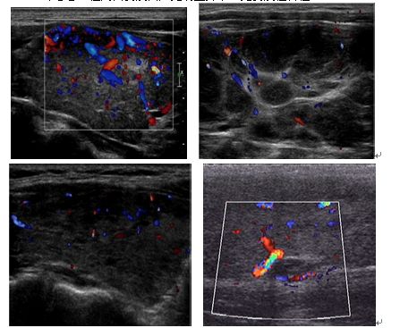 甲状腺结节患者8种症状要当心,老人甲状腺结节病因是什么