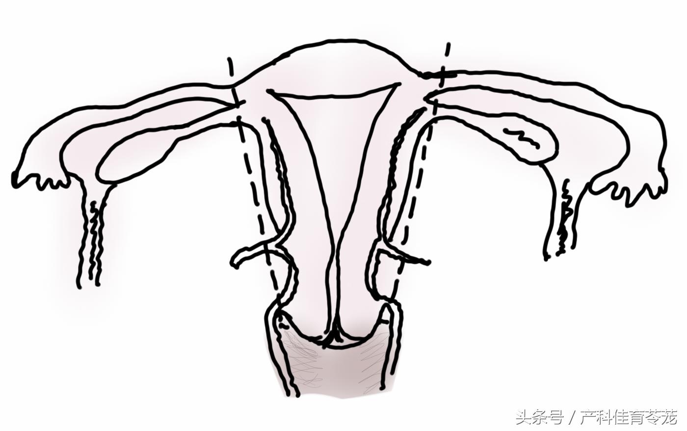 子宫别随便切，以后可能会憋不住尿哦