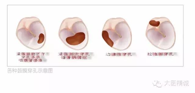 游泳耳朵进水了怎么办啊,游泳如何防止耳朵进水