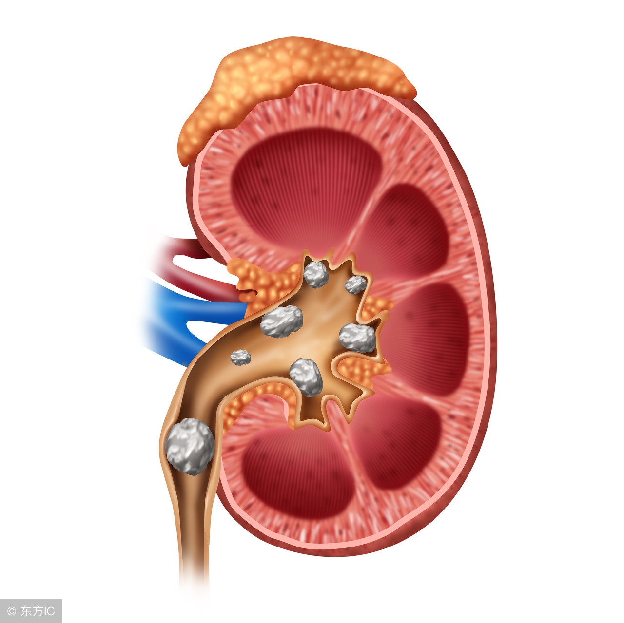 肾结石医院流程,肾结石外科治疗指南