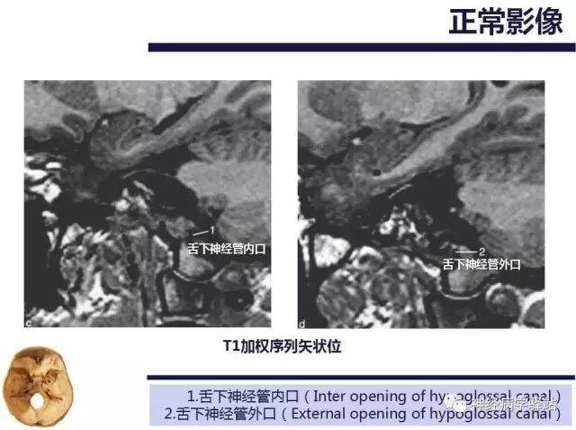 舌下神经和舌咽神经的解剖图,颊神经舌神经解剖图