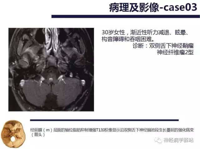 舌下神经和舌咽神经的解剖图,颊神经舌神经解剖图