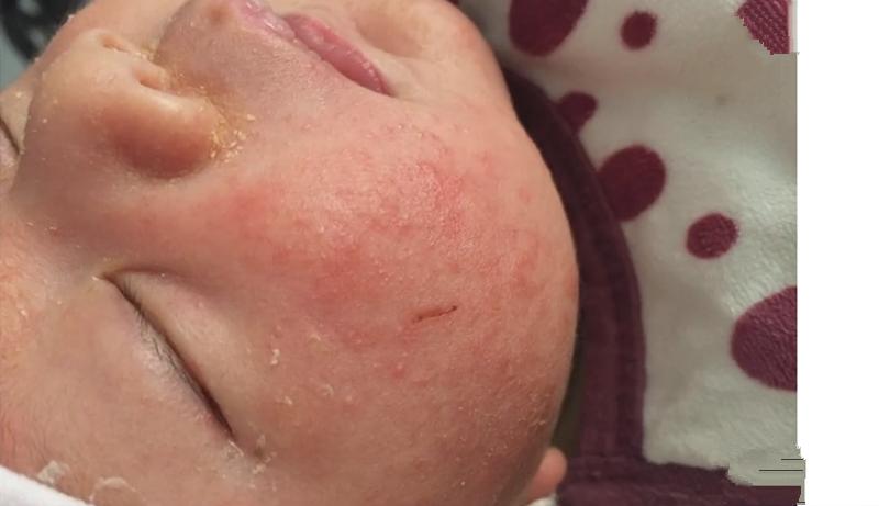 宝宝脸上长湿疹妈妈饮食注意什么,宝宝湿疹妈妈好心疼