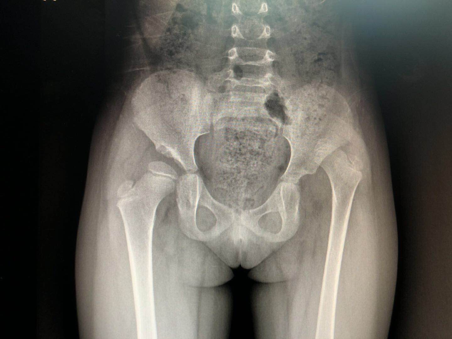 小孩臀线不对称怎么办,小孩臀纹不对称