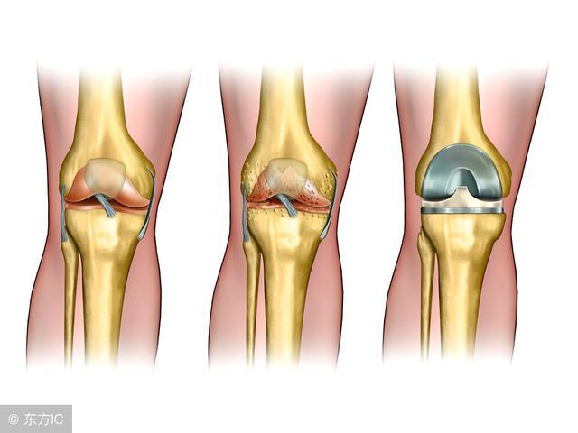 常见的十大膝关节疼痛,老年患者膝关节疾病健康科普