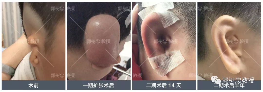 小耳病是什么,小耳症的最佳治疗方法