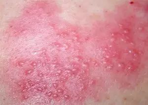 荨麻疹脸上留下的红色印记,长春二院怎么治荨麻疹