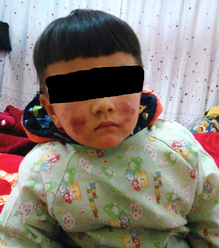 宝宝干性湿疹皮肤渗出溃烂,宝宝渗出性湿疹怎么用药