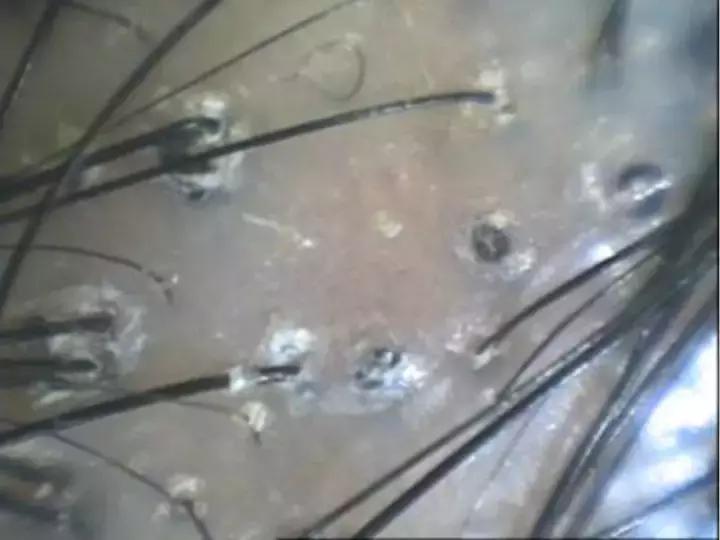 12岁女生头皮屑多什么原因,12岁女孩头皮屑超多是什么原因