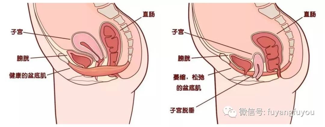 生完孩子漏尿漏大便是怎么回事,生完宝宝尿频漏尿怎么回事