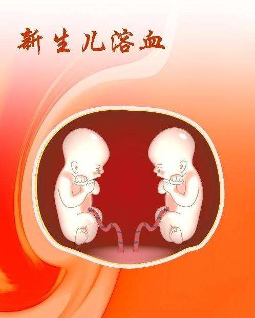 rh血型不合导致新生儿溶血,rh血型不合新生儿几率