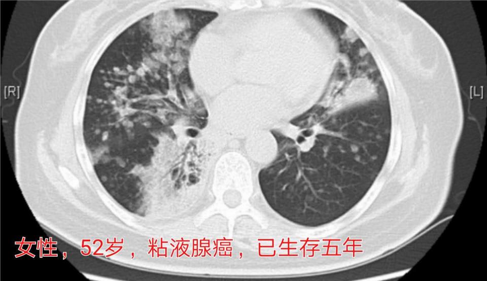 癌症晚期带病长期生存,癌症患者的生存记录