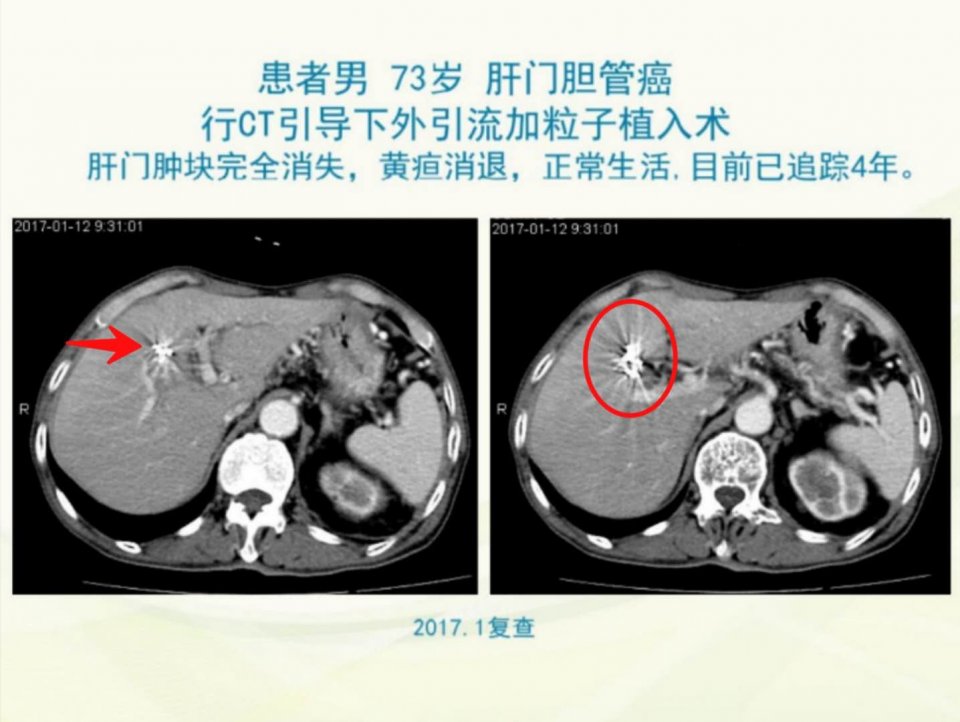癌症晚期带病长期生存,癌症患者的生存记录