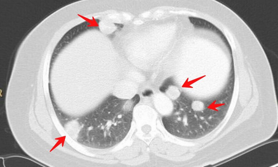 癌症晚期带病长期生存,癌症患者的生存记录
