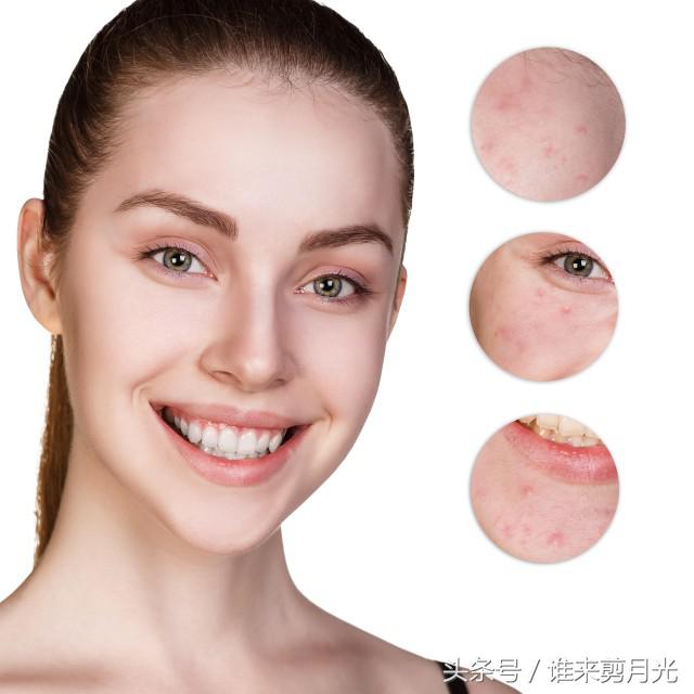 生完孩子后下巴额头长痘什么原因,额头下巴老是反复长痘怎么解决