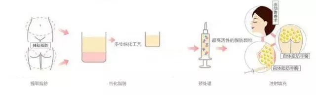 各种吸脂术的优缺点,吸脂原理视频全过程演示图片