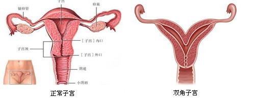 子宫畸形双子宫有什么危害,双角子宫和纵隔子宫同时存在