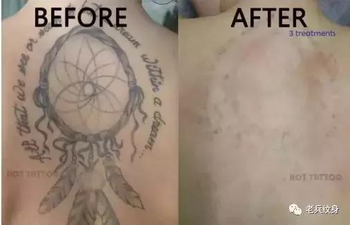 科普洗纹身的那些事儿,洗纹身误区以及洗纹身真实案例