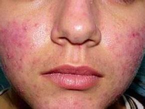 寻常疮怎么治,寻常痤疮用什么药膏