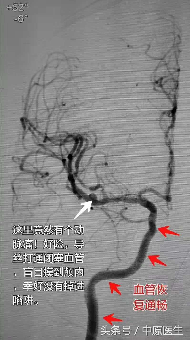 53岁男子脑梗急救室抢救真实纪实,脑动脉闭塞介入治疗视频