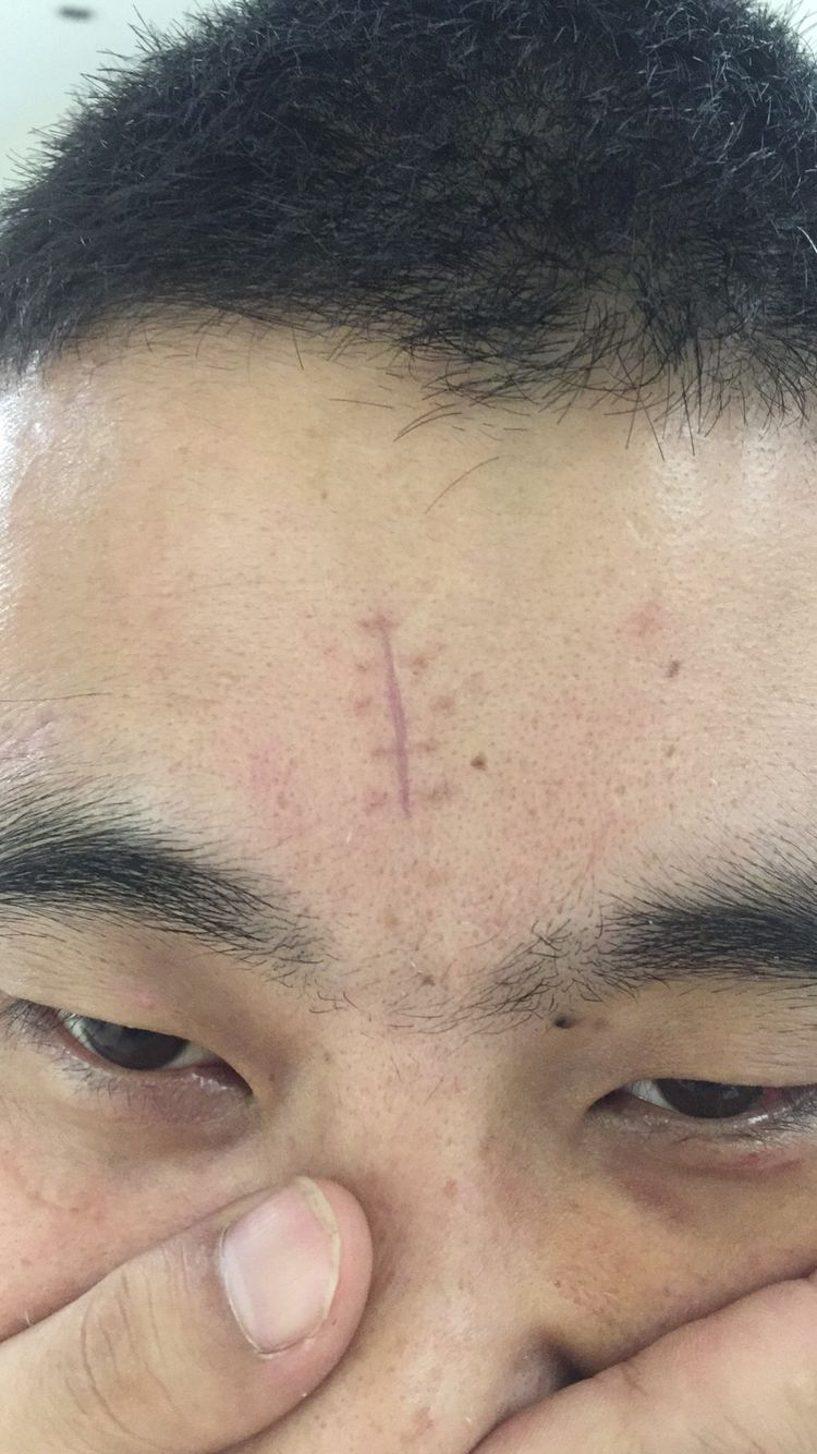 面部外伤后初期疤痕凸起怎么修复,面部外伤凹陷疤痕怎么去除