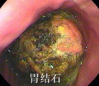 男子胃胀,男子胃结石医生开2大瓶可乐