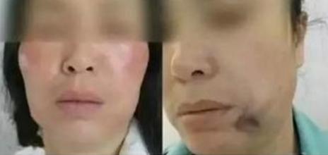 反复线雕面部的优点和缺点,面部线雕失败图片