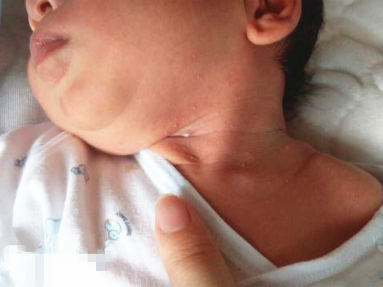 宝宝脖子淹很红了怎么快速恢复,宝宝脖子淹红了怎么快速恢复