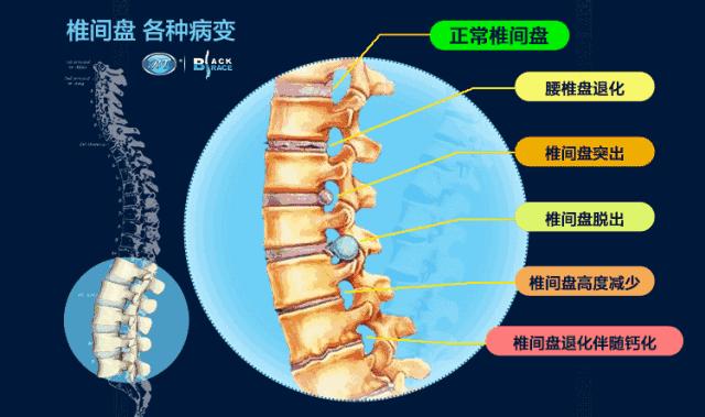 腰突保守治疗8月后还有症状,腰痹通胶囊治疗腰突效果怎样