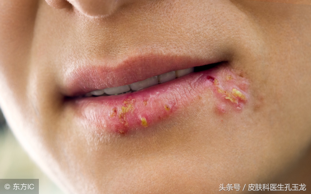 嘴唇长疱疹是哪里上火了,嘴唇上火起泡和单纯疱疹怎么区别