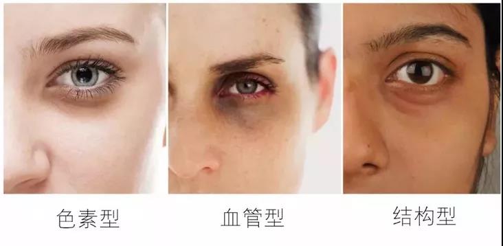眼睛黑眼圈显老怎么办,眼睛黑眼圈大眼袋怎么消除