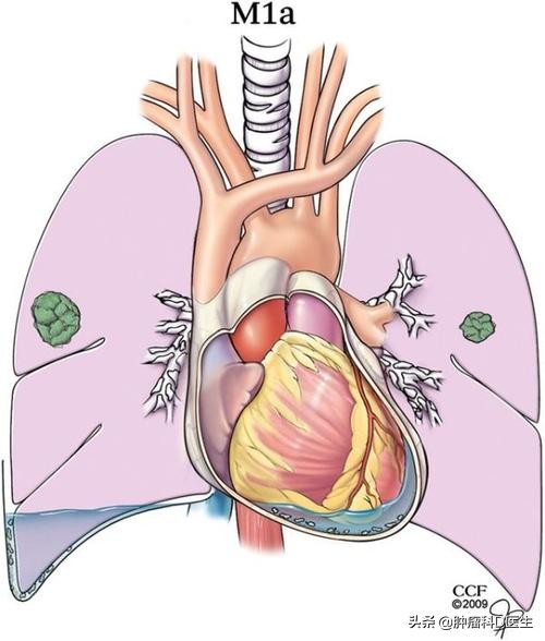 肺癌胸水控制了说明好转了吗,有胸水了还可能是早期肺癌吗