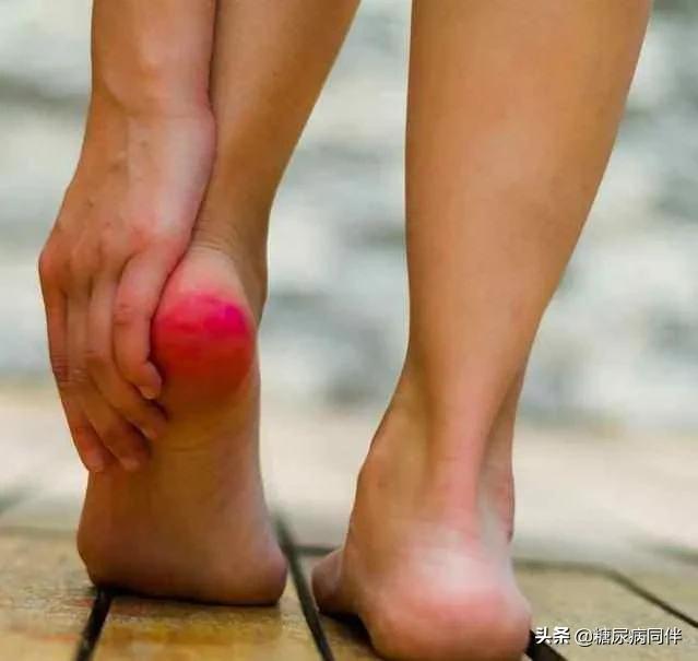 糖尿病足烂脚前有6个症状,糖尿病足早期症状如何治疗