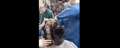 打开死者的肺，才明白有3亿人，在悄悄花钱买死