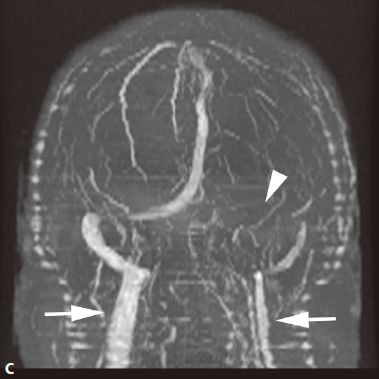 颅内血管轻度狭窄诊断标准,颅内血管先天变异影像