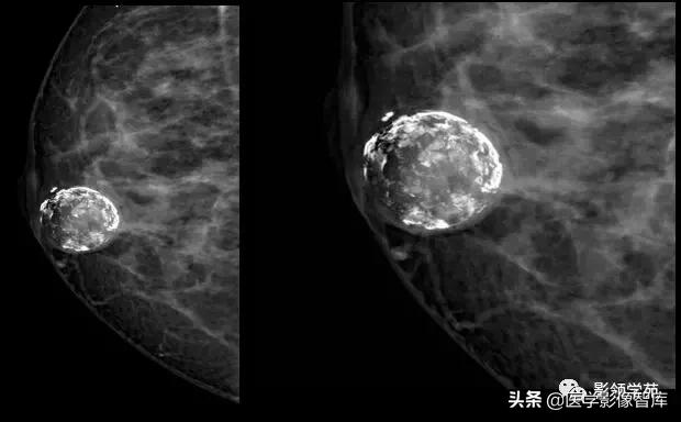 乳腺钙化怎么区分良性和恶性,乳腺钙化的诊断与分级