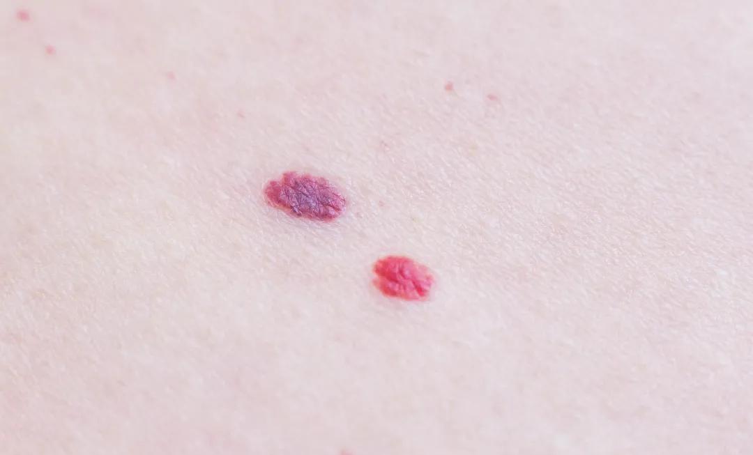 身上长了红点看什么科,身上长出这种小红点要小心