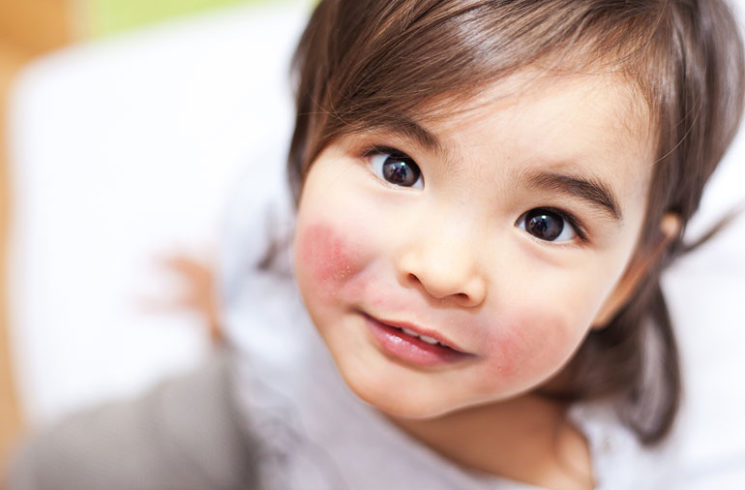 宝宝怕晒怎么护肤,宝宝冬天吹风脸蛋红怎么办