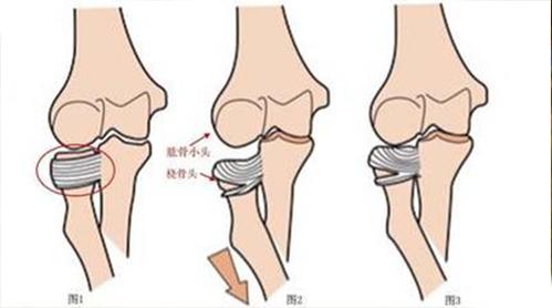 孩子胳膊脱臼好几次是怎么回事,孩子胳膊脱臼什么原因