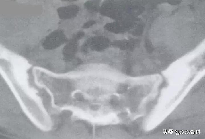 5岁小孩强直性脊柱炎的诊断,强直性脊柱炎诊断标准b27