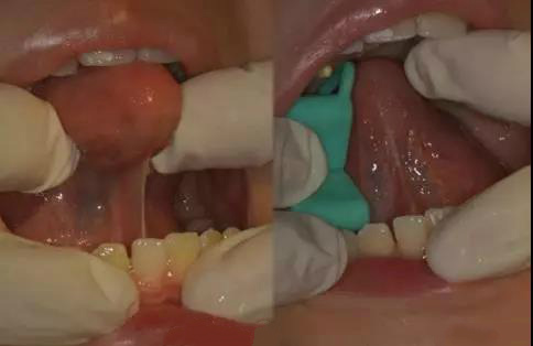 4岁舌系带过短要不要剪,什么是舌系带短图片