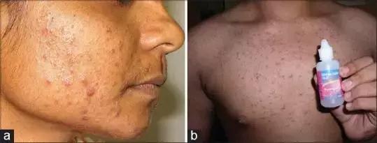 汉珍草湿疹膏含激素吗,宝宝湿疹可以涂湿疹霜吗