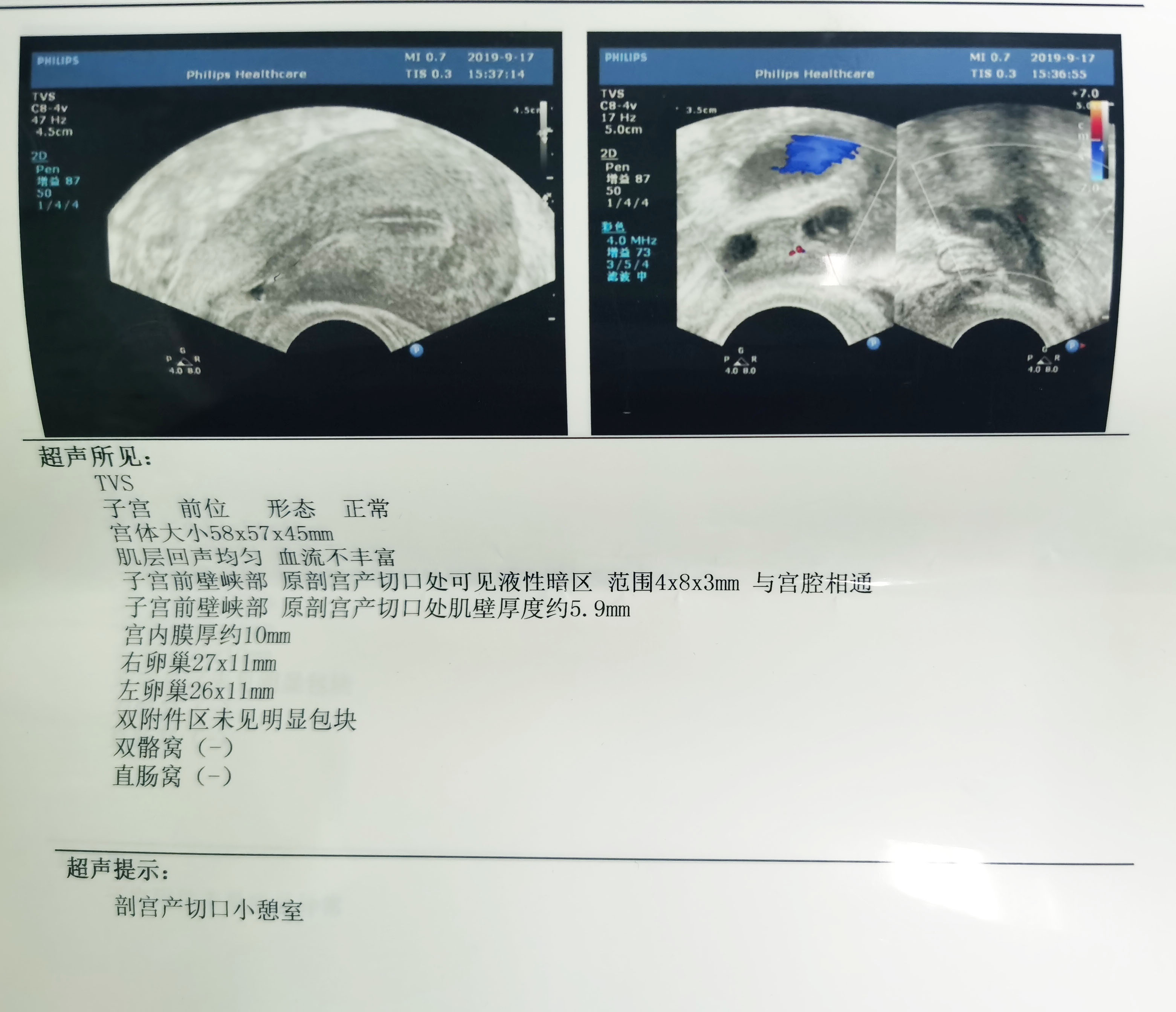 两个大头宝宝，让我经历了两次剖宫产