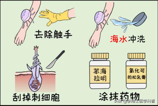 被水母蛰伤后处理视频英文,被水母蜇科普动画
