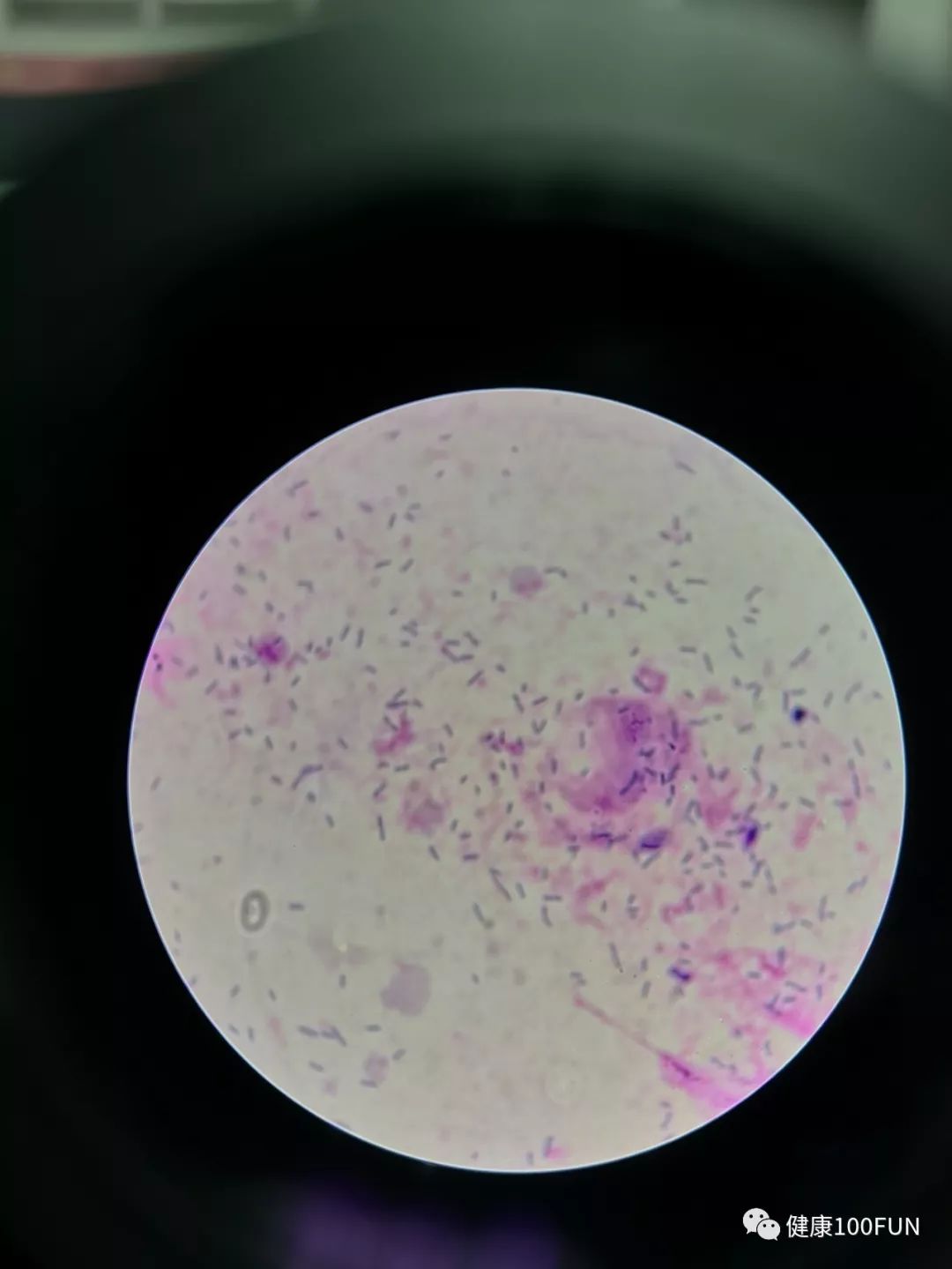 鏈堢粡鏈熷闃翠笉閫忔皵婀跨棐,濡囧コ涓嬮儴婀跨棐鐢ㄤ粈涔堣嵂